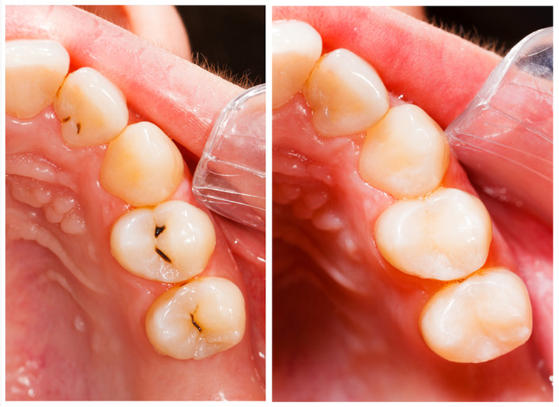 fillings_img https://fsm.dp20.net/wp-content/uploads/2024/02/fillings_img.jpg