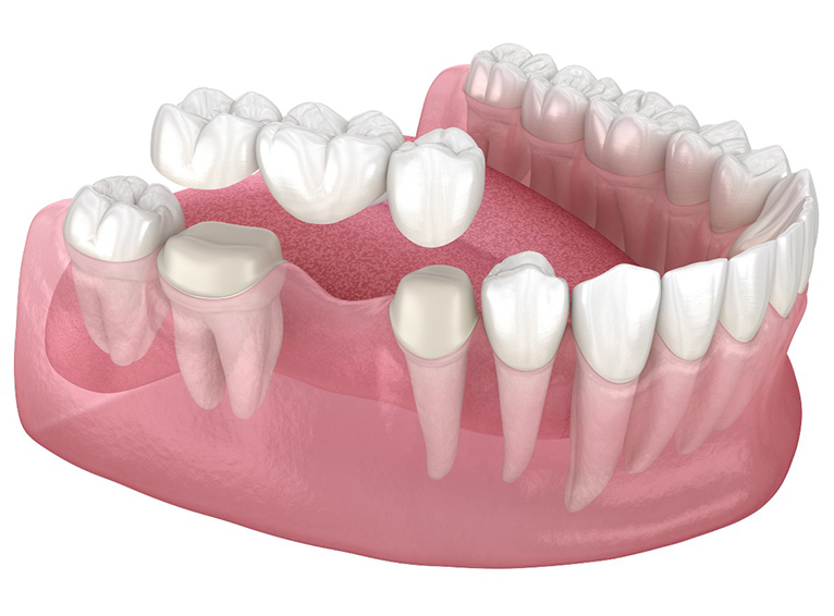 Dental-bridges https://fsm.dp20.net/wp-content/uploads/2024/03/Dental-bridges.jpg