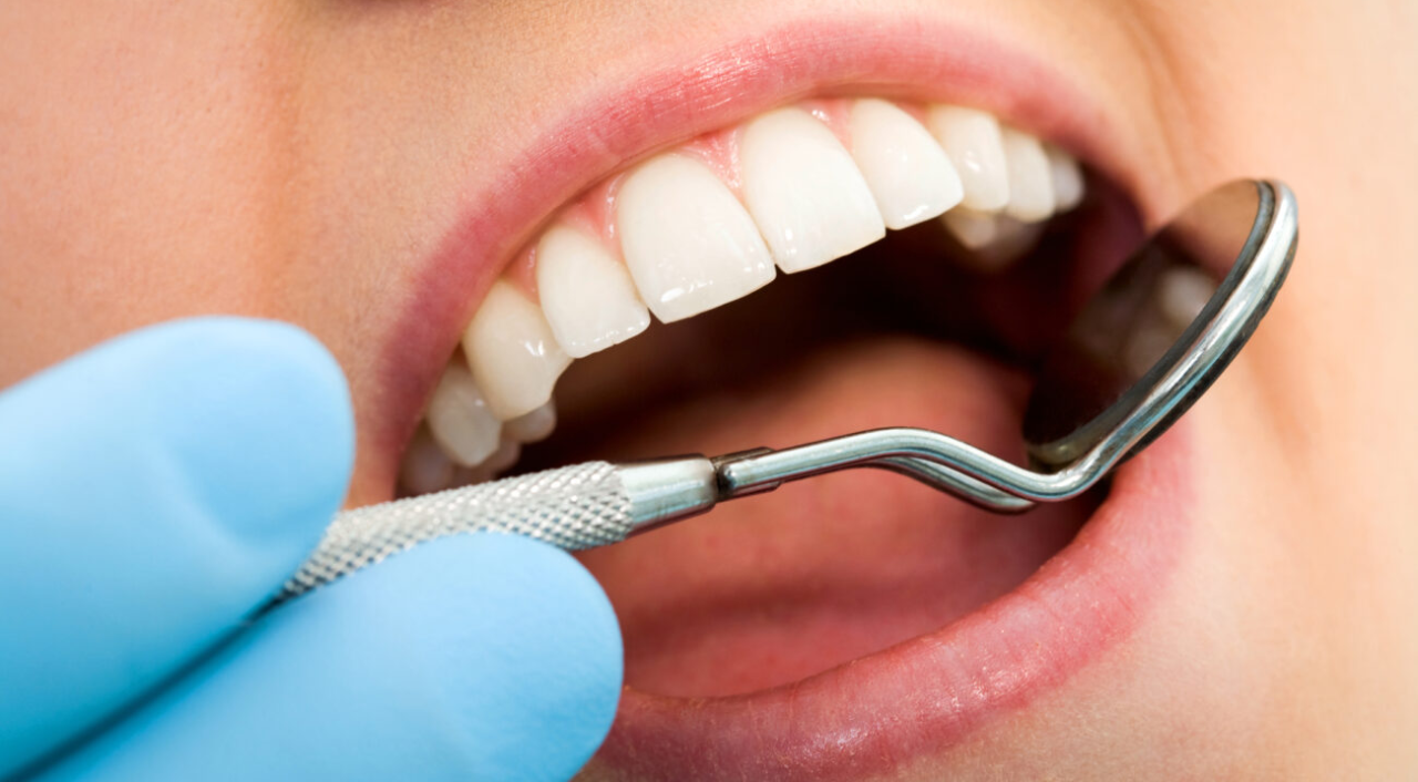 How Do Cavities Form?