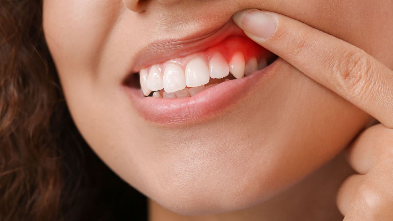 6 Signs That You May Have Gum Disease