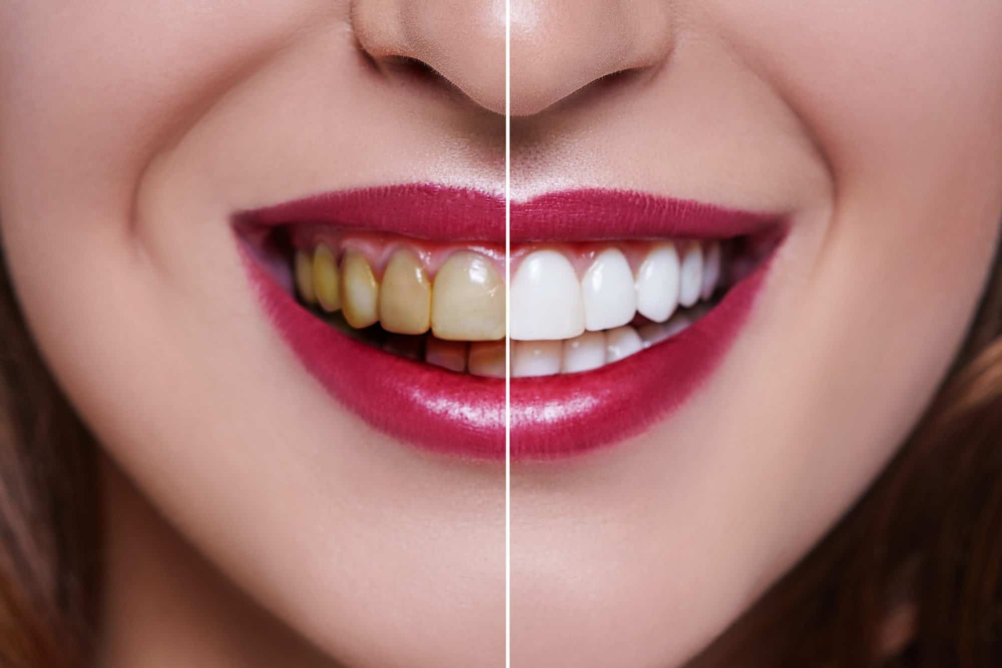 how-long-does-teeth-whitening-last-scaled https://fsm.dp20.net/wp-content/uploads/2024/03/how-long-does-teeth-whitening-last-scaled-1.jpg