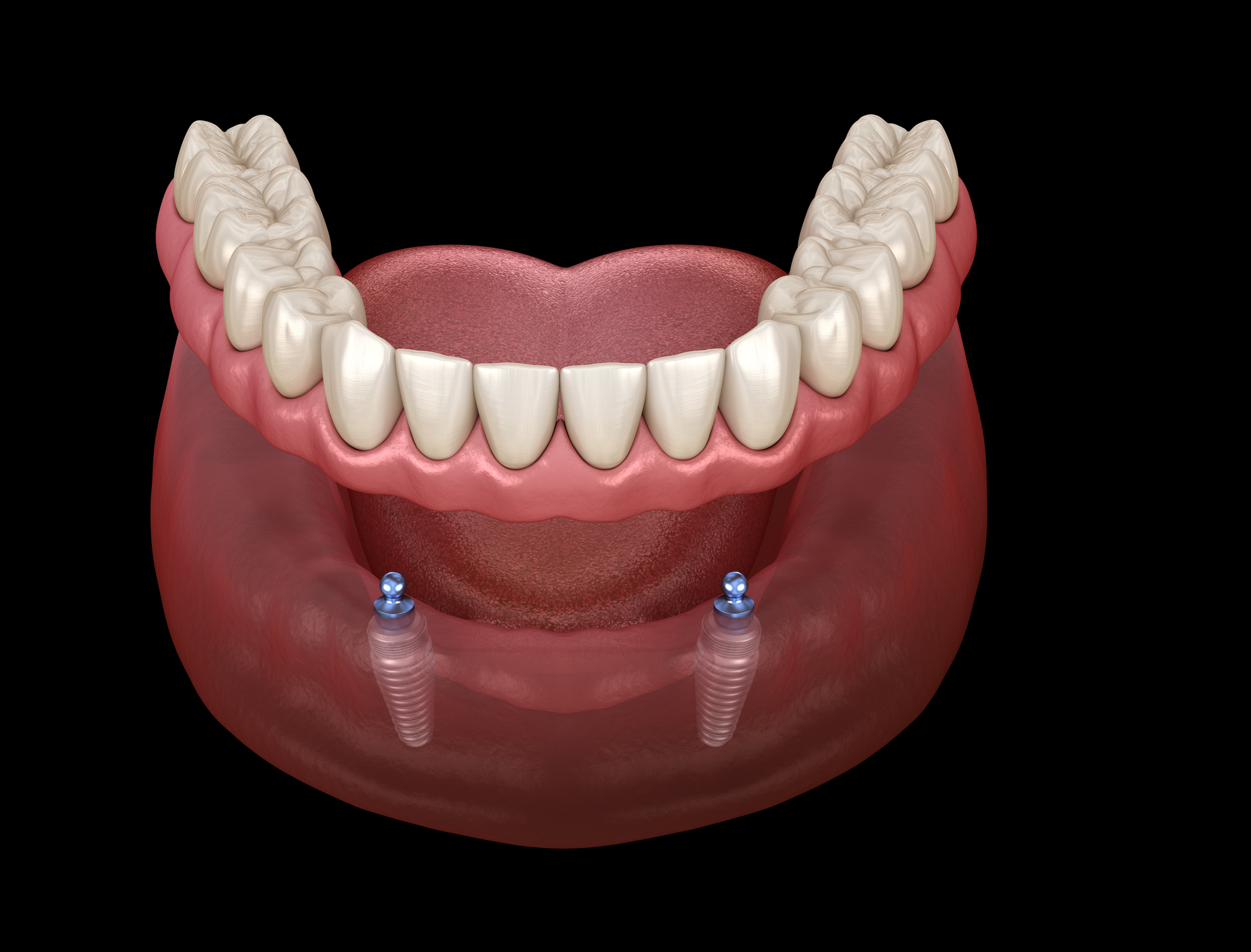 Mandibular removable prosthesis All on 2 system supported by implants with ball attachments. Medically accurate dental 3D illustration Mandibular removable prosthesis All on 2 system supported by implants with ball attachments. Medically accurate dental 3D illustration